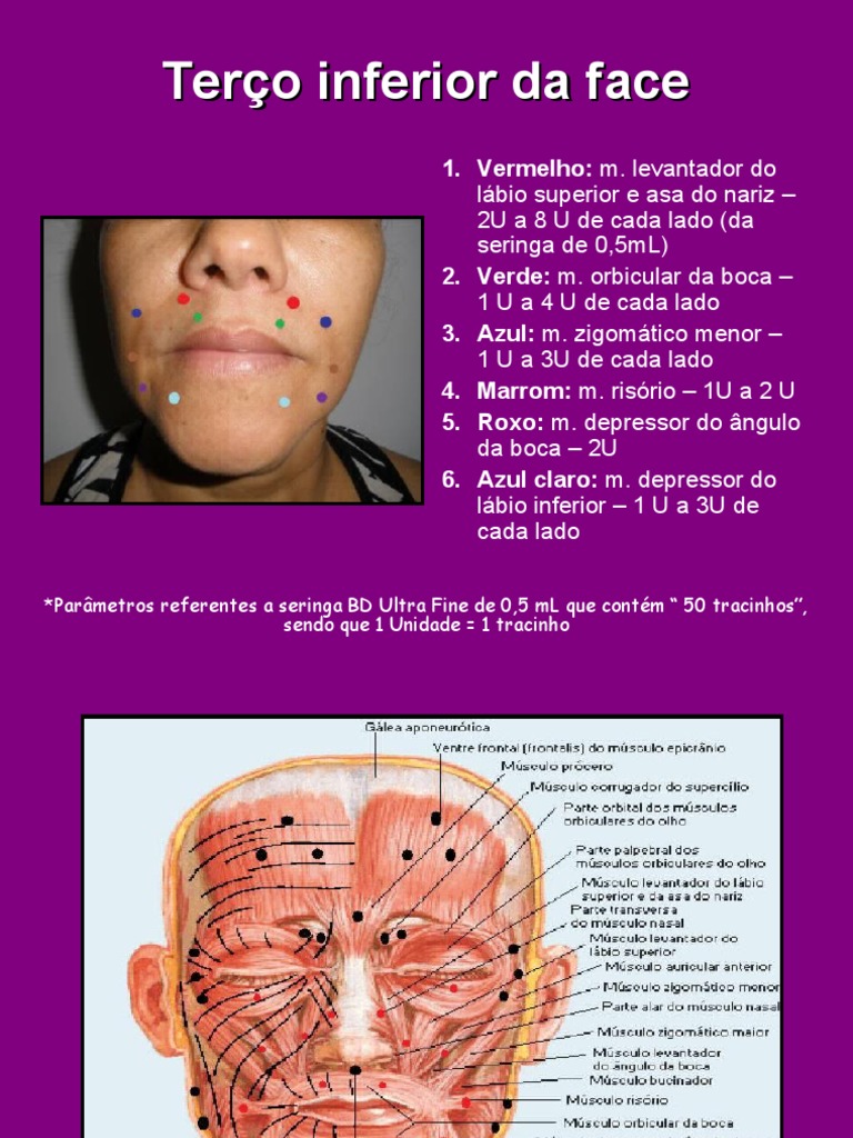 Pontos de Aplicação de Botox na Face | PDF | Anatomia humana ...