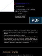 Tecnicas de Restauracion de Postes en Conductos Amplios