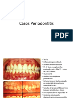 casos periodontitis