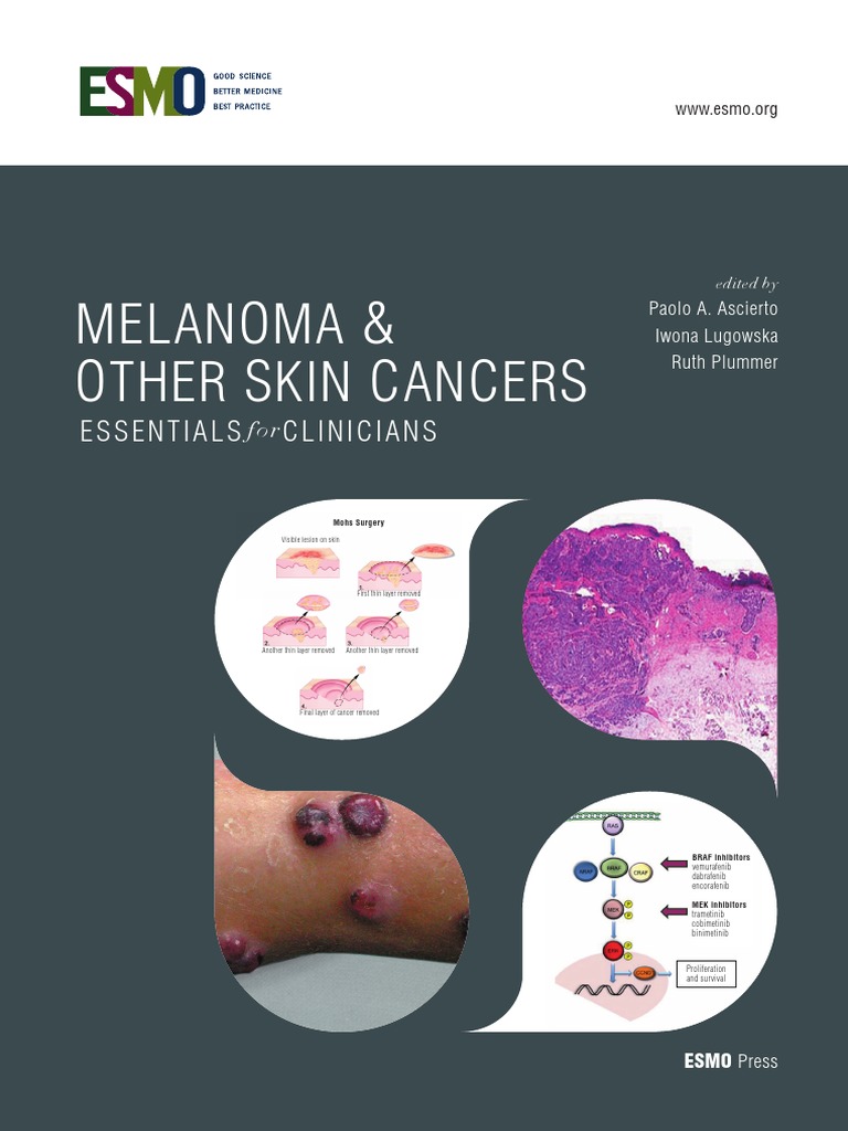 ESMO Essentials For Clinicians Melanoma and Other Skin Cancers 2021 ...