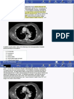 027 Med Aortic Dissection