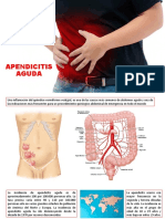 Apendicitis