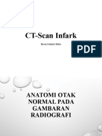 CT Scan Infark Dan Perdarahan Otak