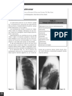 PDF Tuberculosis