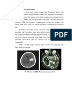 Kontusi dan hematoma intraserebral