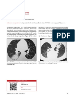 Pulmonary Mycetoma: Radiology Quiz