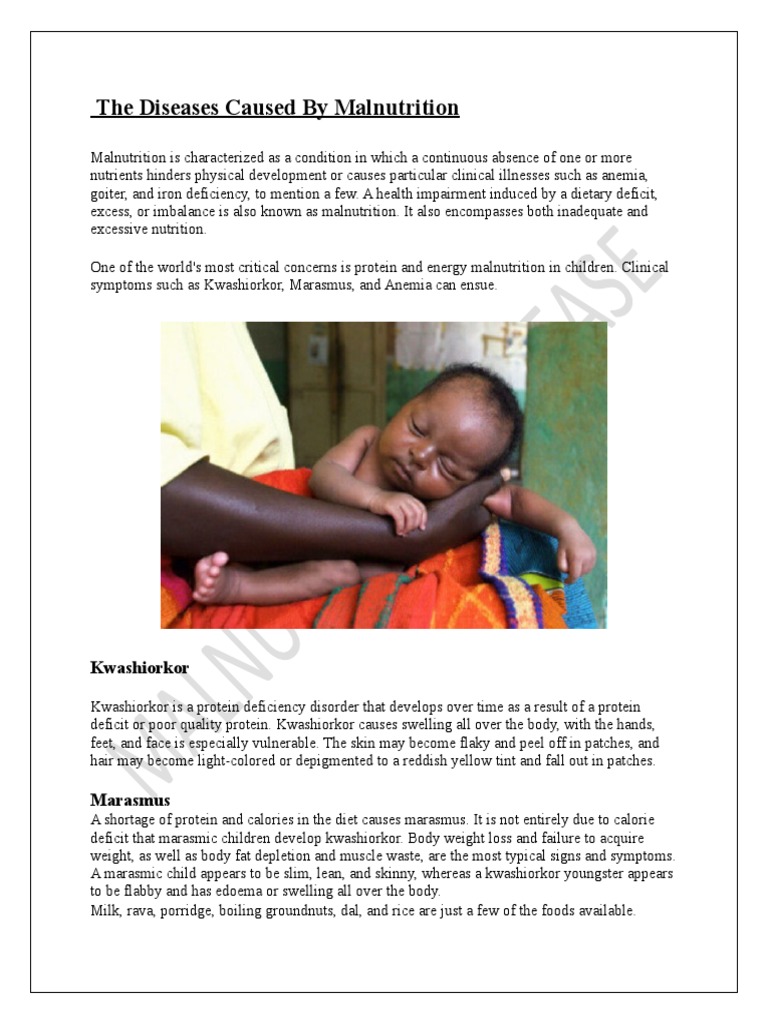 Caused Malnutrition | Download Free PDF | Malnutrition | Vitamin