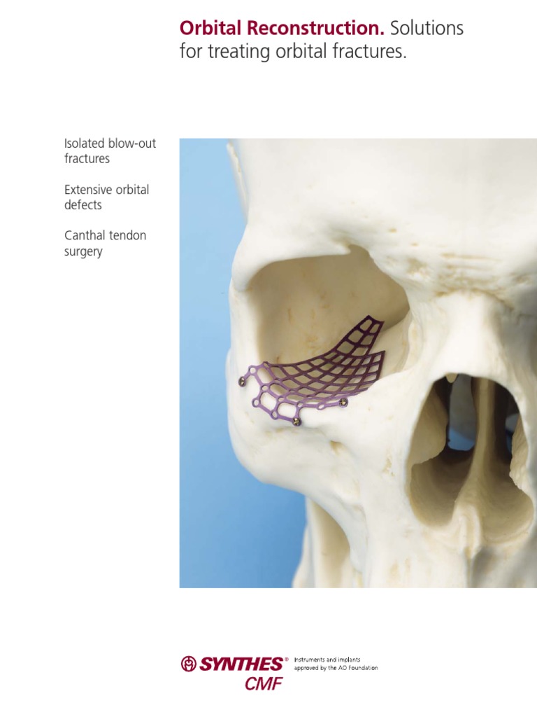 Orbital Reconstruction. Solutions For Treating Orbital Fractures PDF