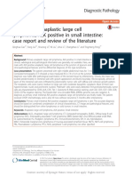 Primary Rare Anaplastic Large Cell Lymphoma, ALK Positive in Small Intestine: Case Report and Review of The Literature