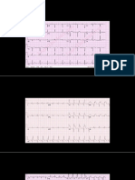 EXEMPLE ECG IM