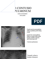 Contusio Pulmonum