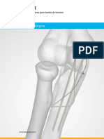 Acumed Surgical Technique ES Tension Band Pin System ESSPF00 04 A