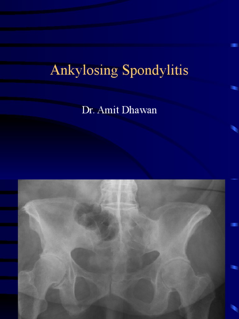 Ankylosing Spondylitis Insights | PDF | Medical Specialties | Skeletal ...