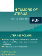 Benign Tumors of Uterus