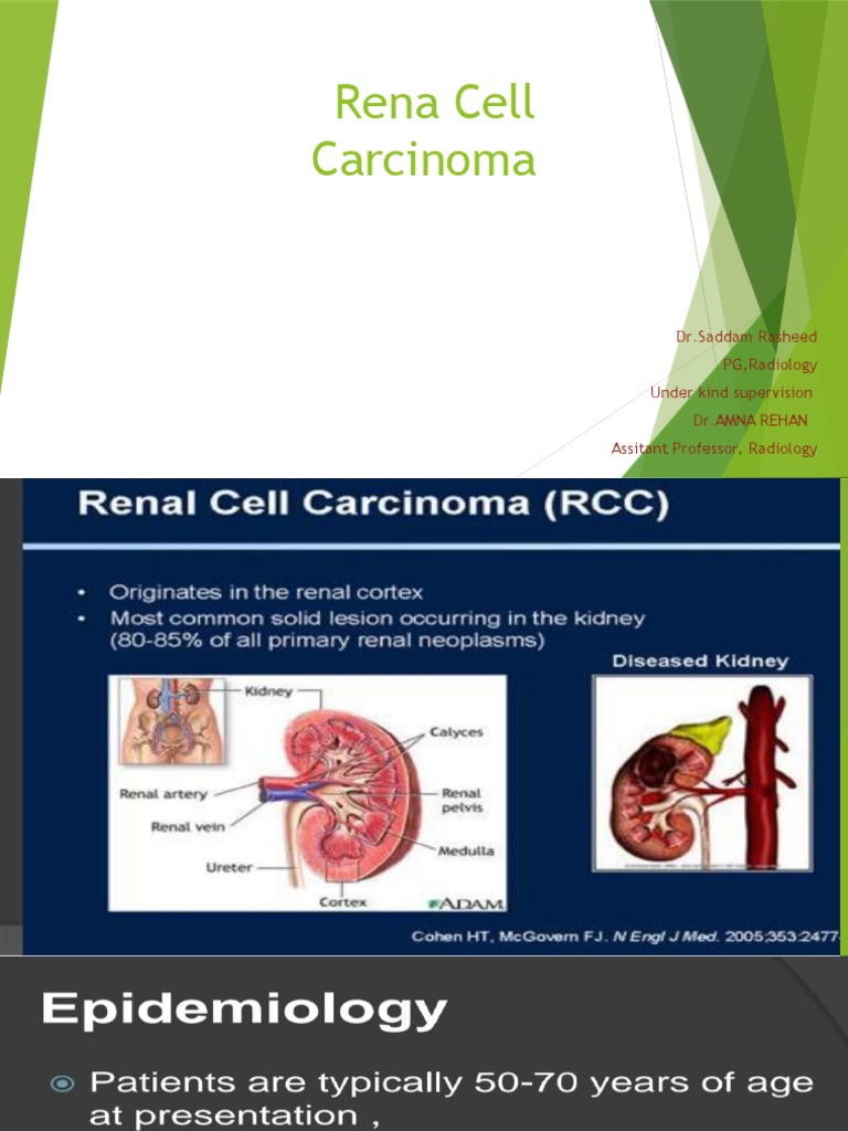 Rena Cell Carcinoma: DR - Saddam Rasheed PG, Radiology Under Kind ...