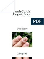 Contoh-Contoh Penyakit Jamur