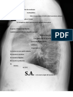 Asbestosis