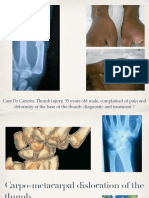 3-2 CMC Joint Dislocation DIU 2022