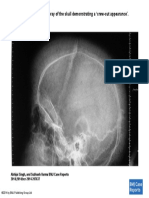 Sagittal View of The X-Ray of The Skull Demonstrating A Crew-Cut Appearance'