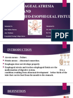 Esophageal Atresia