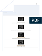 1.4.3 Splenic Infarcts - Ultrasound Cases 3