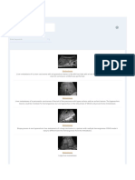 Metastasis - Ultrasound Cases