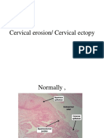 Cervical Erosion/ Cervical Ectopy
