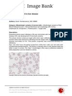 60811-Target and Spur Cell in Liver Disease