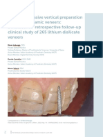 Minimally Invasive Vertical Preparation Design For Ceramic Veneers: A Multicenter Retrospective Follow-Up Clinical Study of 265 Lithium Disilicate Veneers