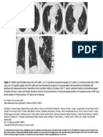 Figure 2. Probable Usual Interstitial Pneumonia (UIP) Pattern. (A-C) Transverse Computed Tomography (CT) Section, (D) Coronal Reconstruction of Both