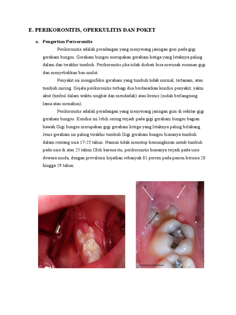 Perikoronitis dan Operkulitis Gigi Bungsu | PDF