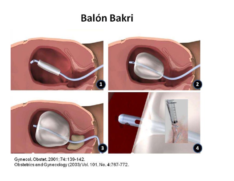 Afiche Taponamiento Uterino - Balón de Bakri | PDF