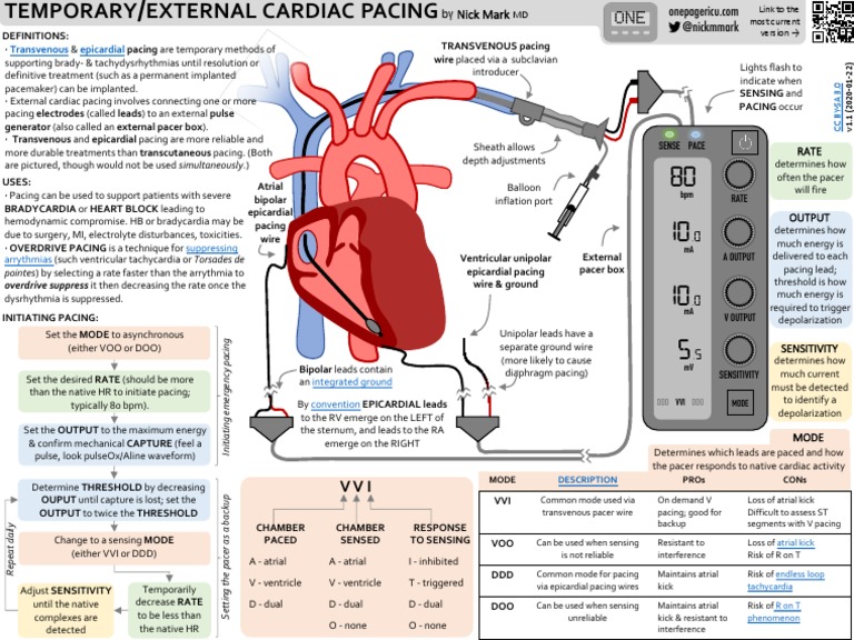 ICU One Pager External Pacemakers v11 | PDF | Artificial Cardiac ...