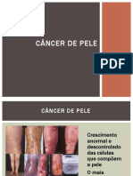 Câncer de Pele