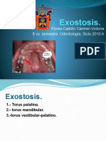 Exostosis