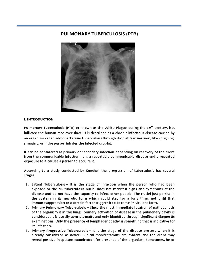 Understanding Pulmonary Tuberculosis | PDF | Tuberculosis | Infection