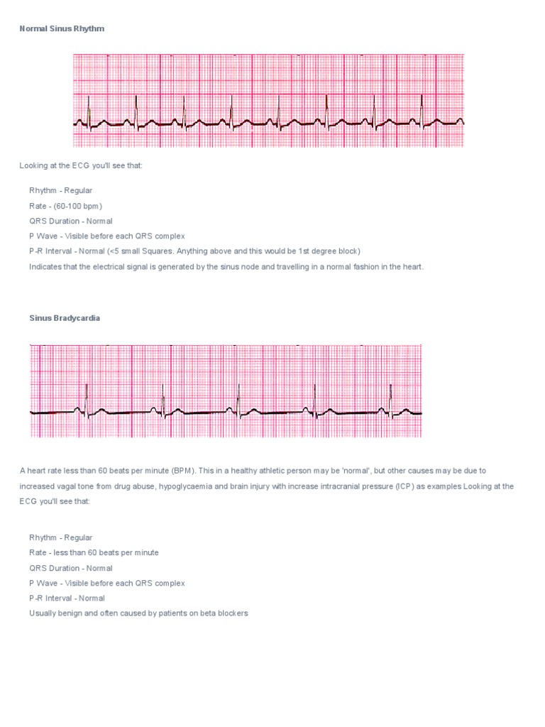 ECG Abnormalities | PDF