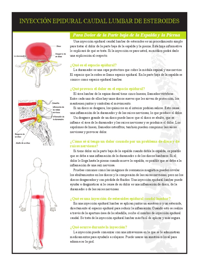 Lumbar Esi Caudal Spanish PDF Inyección (medicina) Dolor
