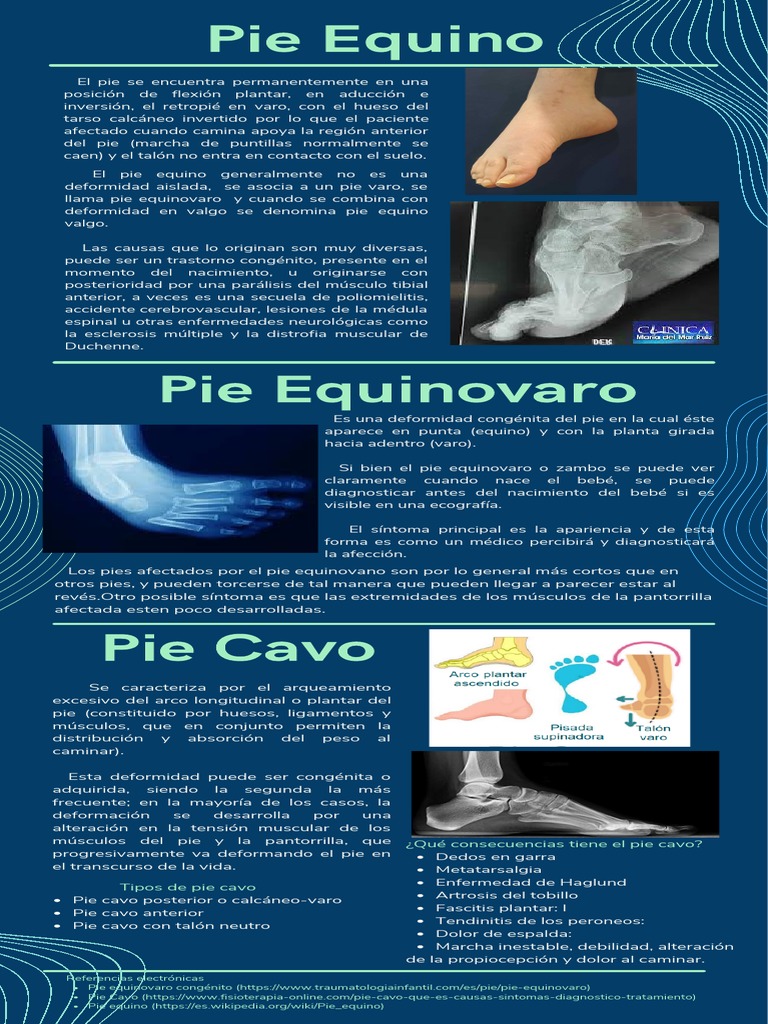 Pie Equino, Varo, y Equinovaro PDF Pie Anatomía humana