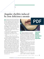 Angular Cheilitis Induced Defisiensi Besi