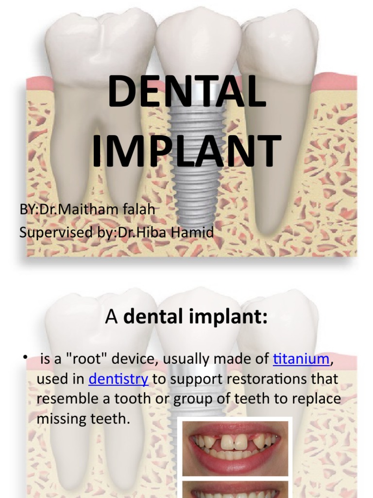 Dental Implants: Types, Benefits, and Procedures | PDF | Dental Implant ...