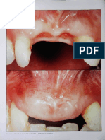 CX PLAST PERIO Functional and Esthetic Outcome Enhancement of Periodontal Surgery by Application 