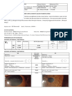 AB - Bukanesa Pa'O - OD KSI + Moderate Lens Dislokasi (Grade 2) + OS Katarak Senil Mature (OS ECCE + IOL) - Compressed