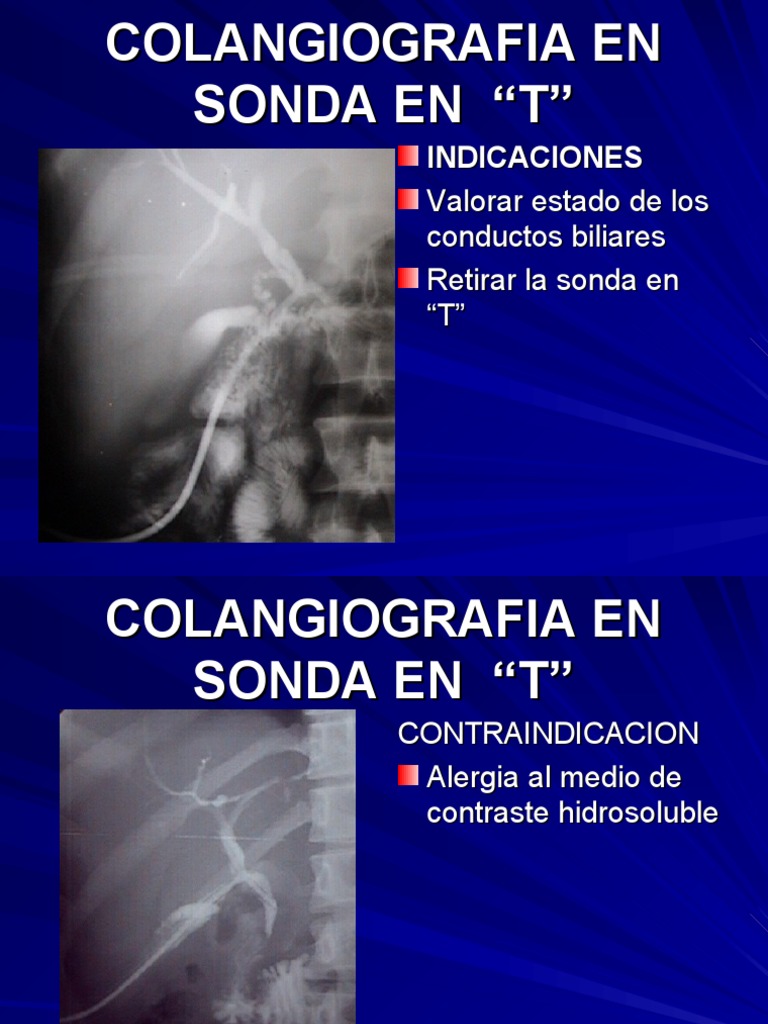 Colangiografía en Sonda en 