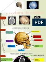 Fractura de Cráneo