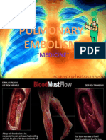 Pulmonory Embolism