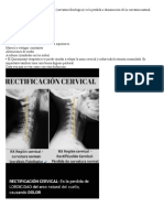 La Rectificación de La Lordosis Cervical