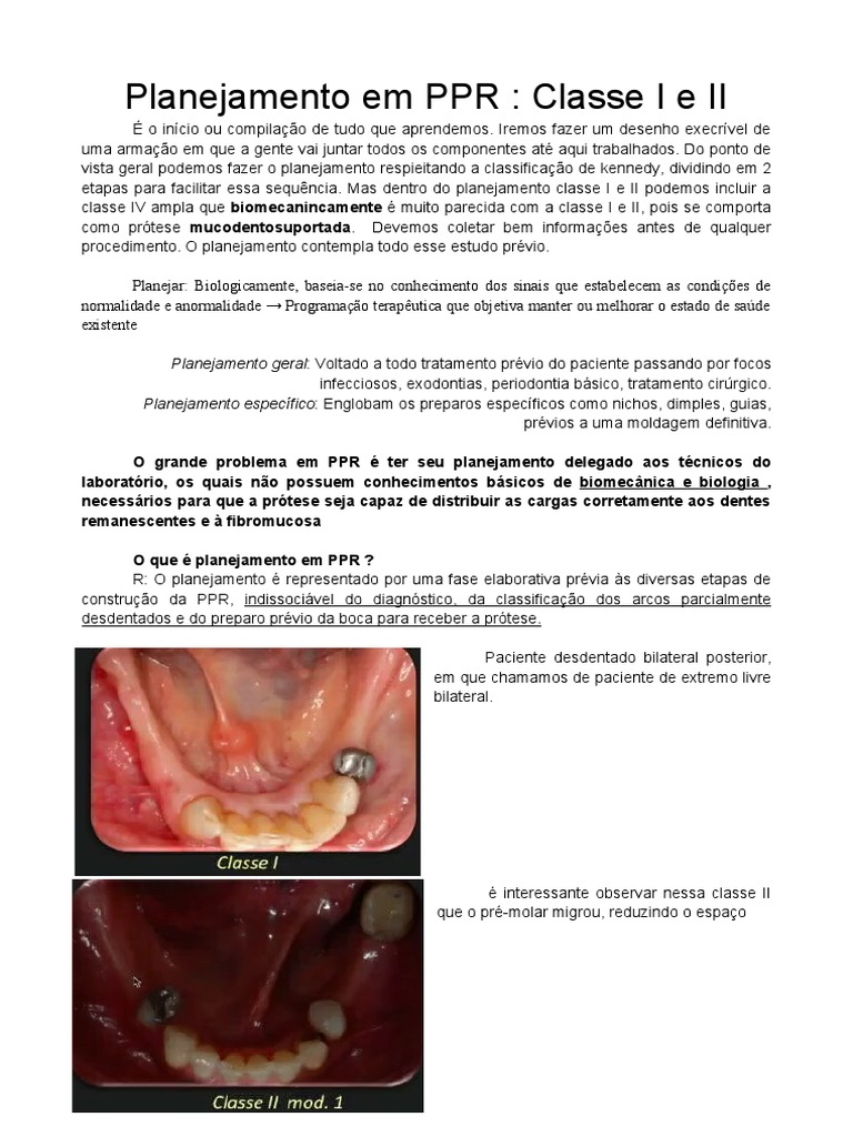 Planejamento em PPR: Classes I e II | PDF | Dente | Prótese