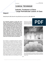 Case Report/Clinical Technique Nonsurgical Endodontic Treatment of Dens Invaginatus With Large Periradicular Lesion: A Case