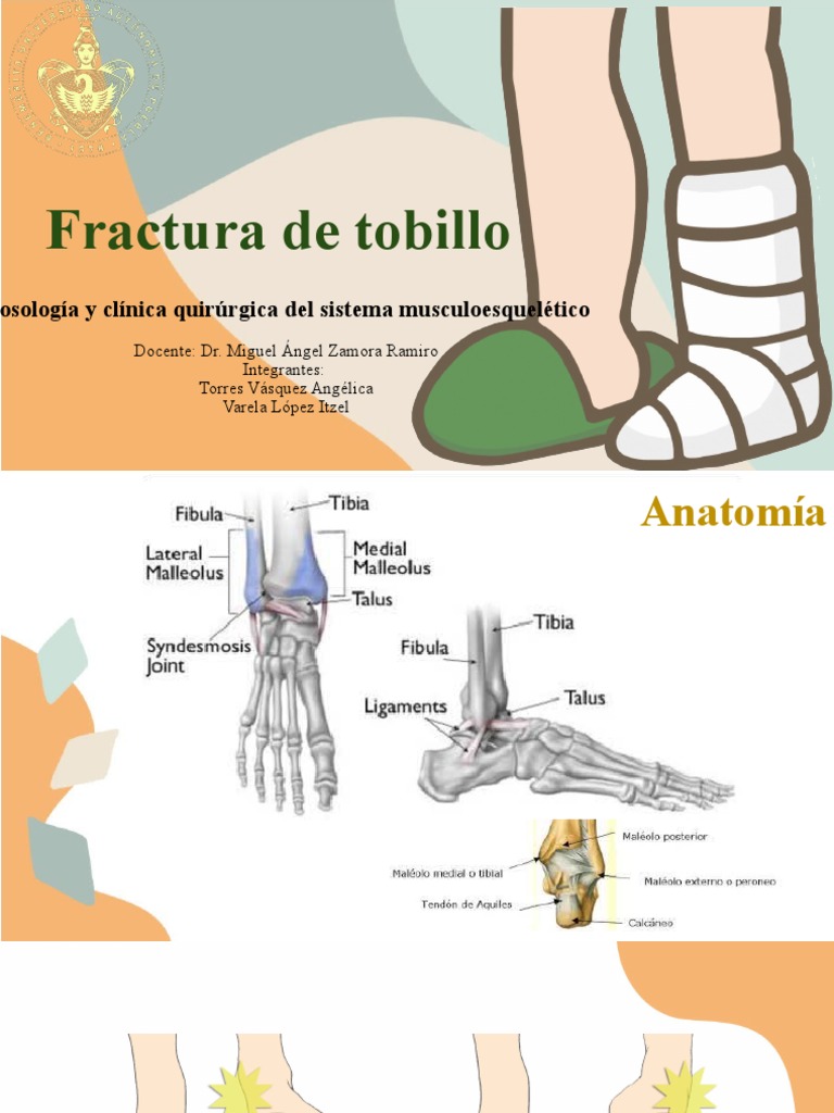 Fractura de Tobillo | PDF | Tobillo | Pie